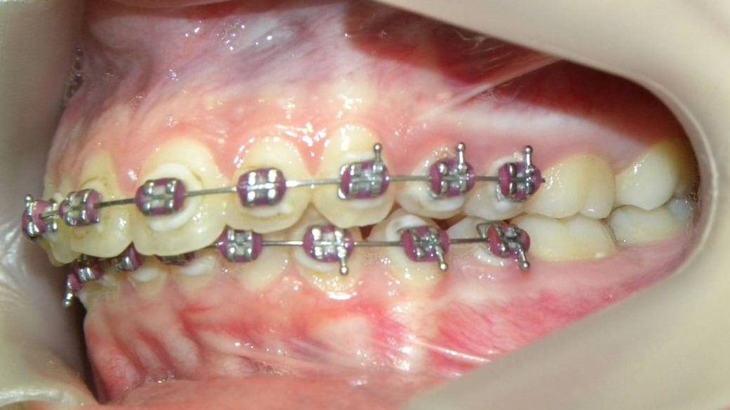 Lateral Izquierda