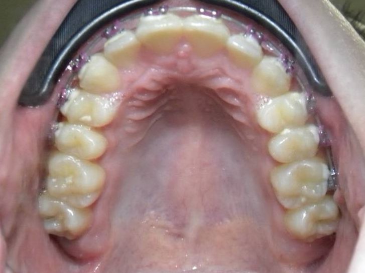 Oclusal Superior