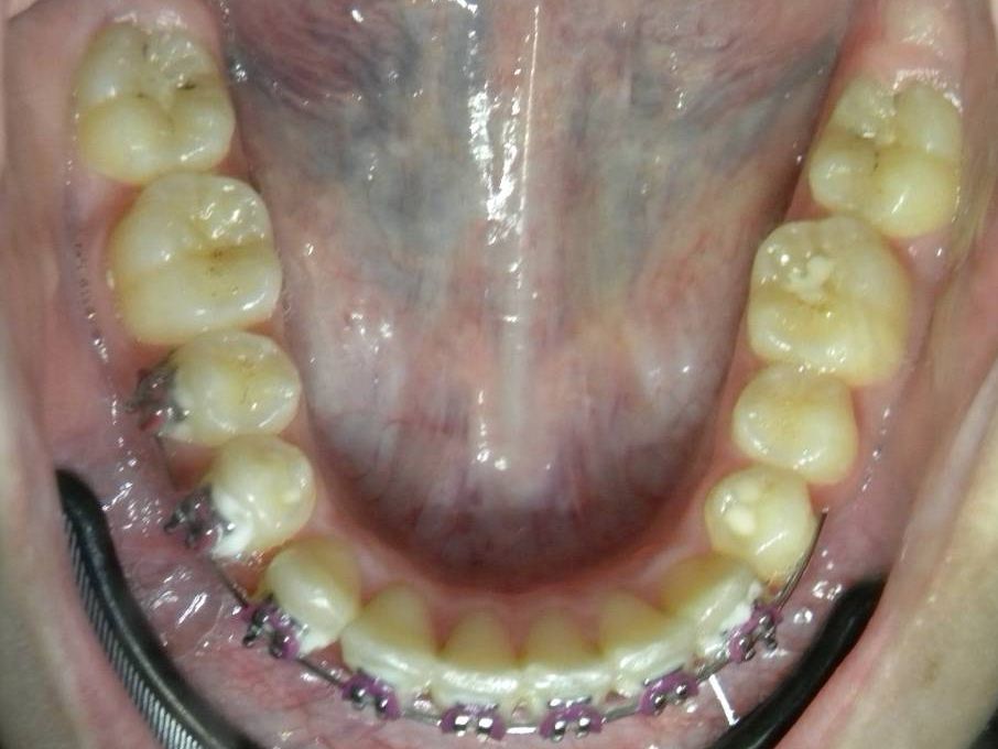 Oclusal Inferior