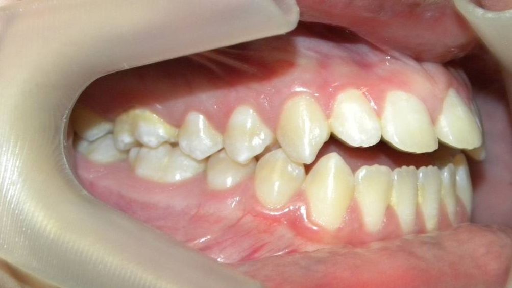 Lateral Derecha