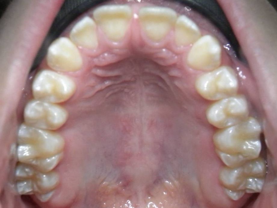 Oclusal Superior