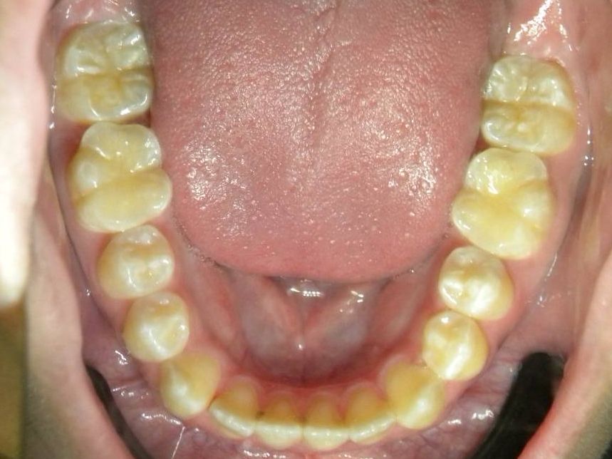Oclusal Inferior