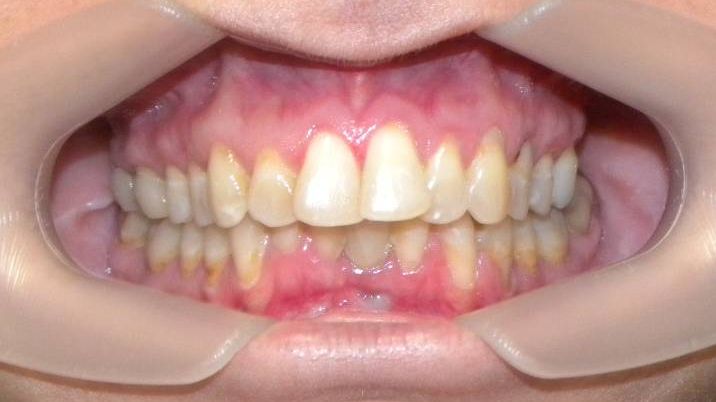 Frontal (Oclusión)