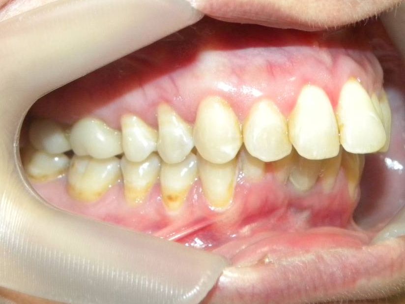 Lateral Derecha
