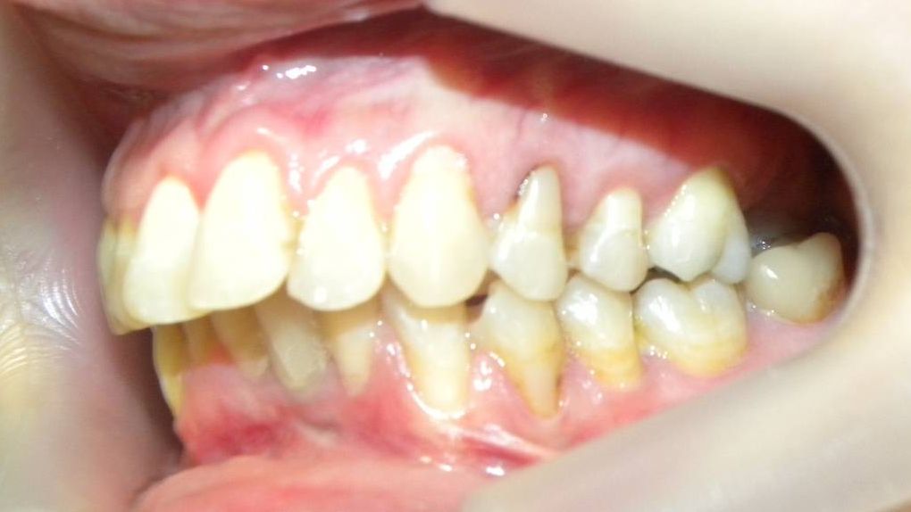 Lateral Izquierda