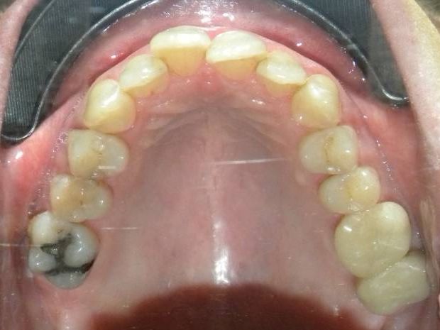 Oclusal Superior