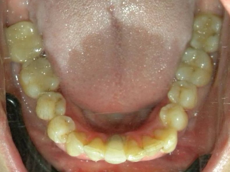 Oclusal Inferior