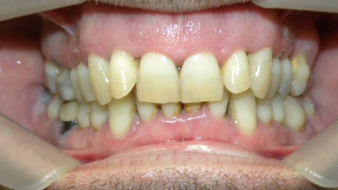 Frontal (Oclusión)