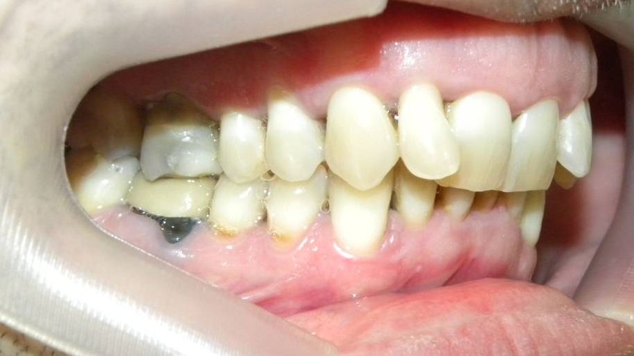 Lateral Derecha