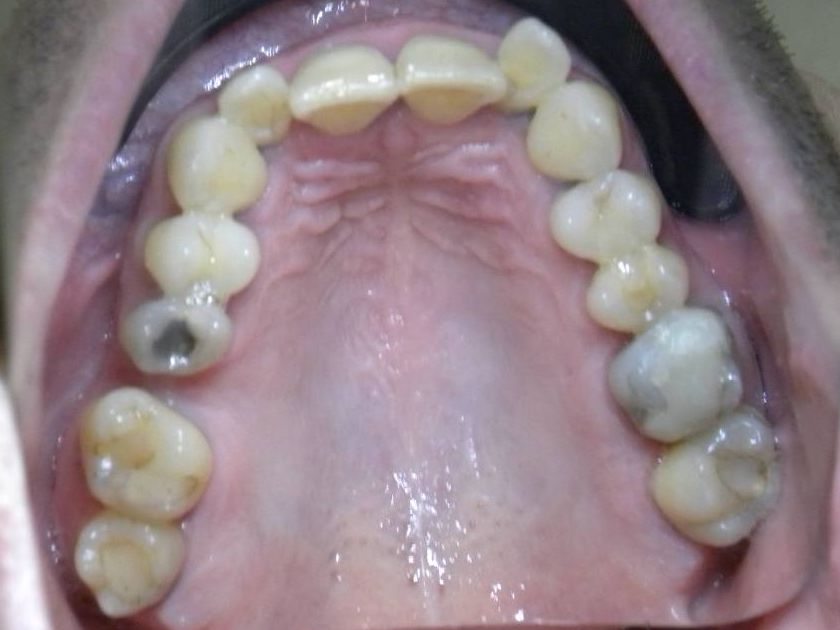 Oclusal Superior