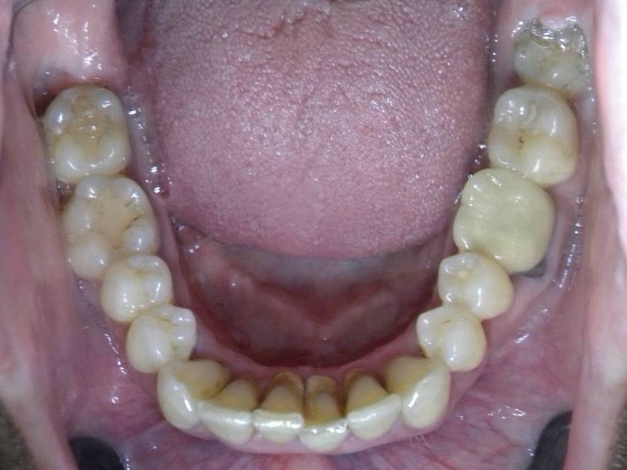 Oclusal Inferior