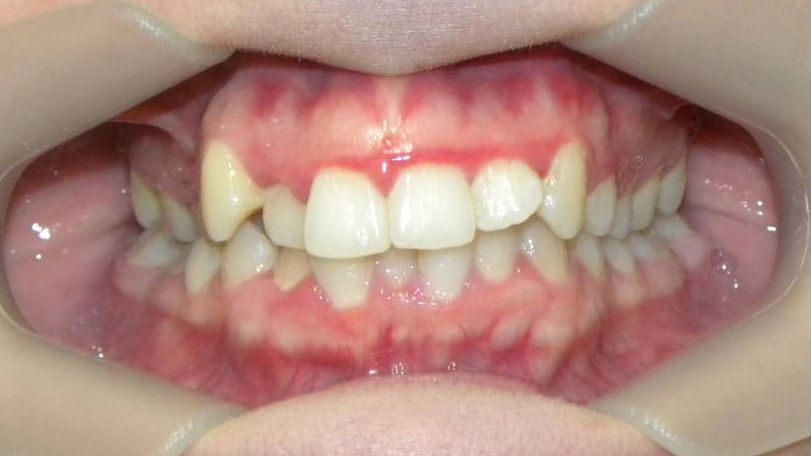 Frontal (Oclusión)