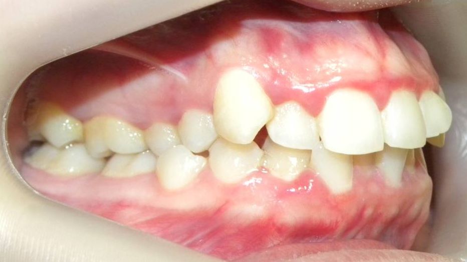 Lateral Derecha