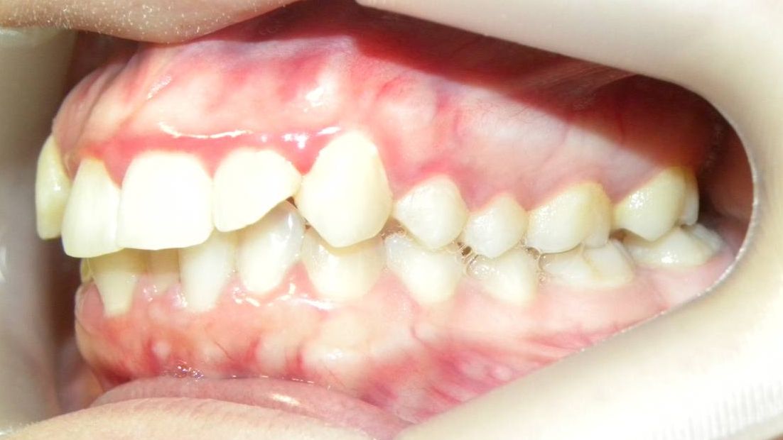 Lateral Izquierda