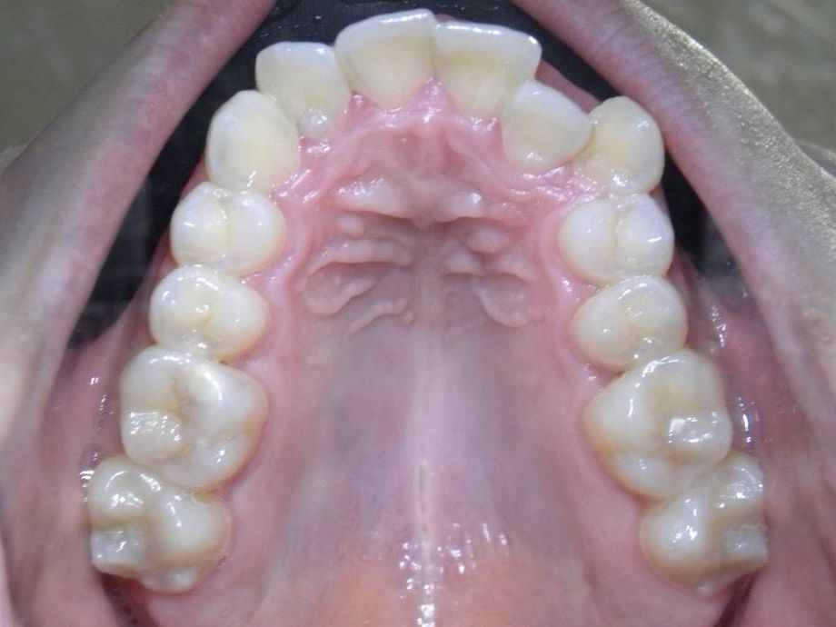 Oclusal Superior