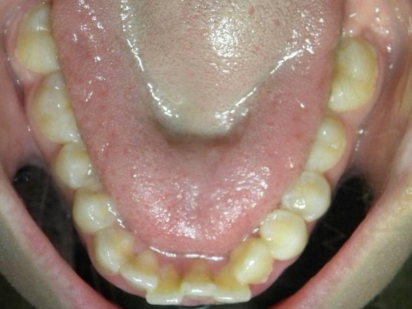 Oclusal Inferior