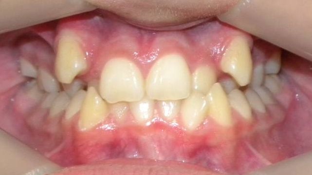 Frontal (Oclusión)