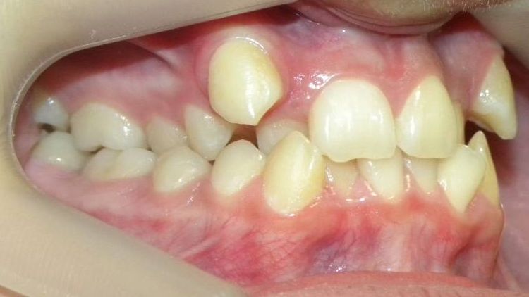 Lateral Derecha