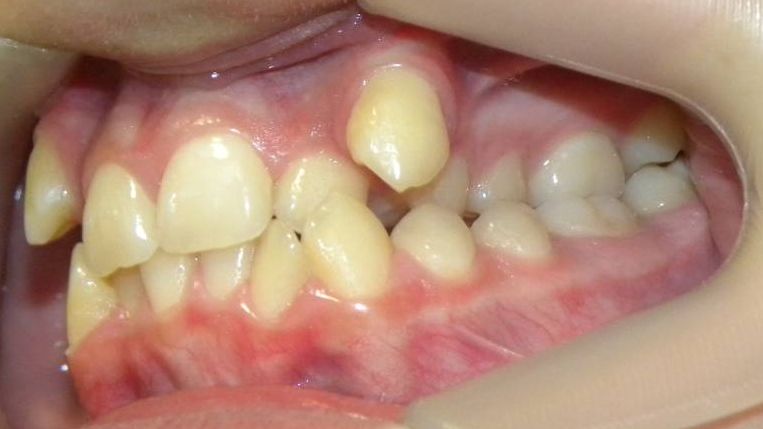Lateral Izquierda