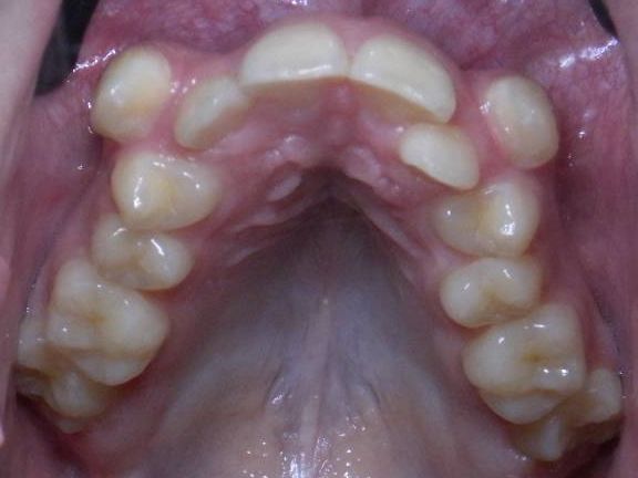 Oclusal Superior