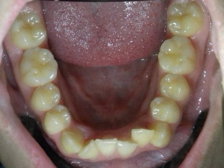 Oclusal Inferior