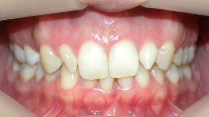Frontal (Oclusión)
