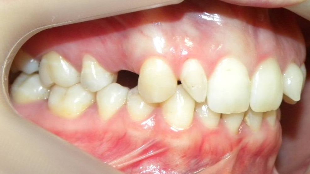 Lateral Derecha