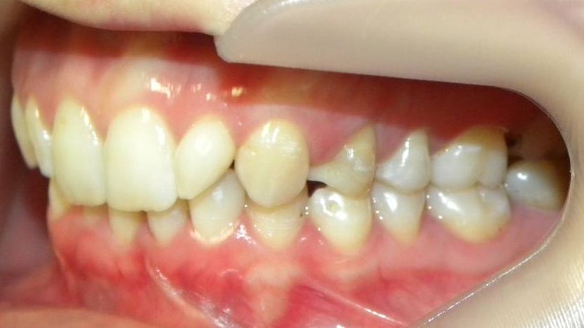 Lateral Izquierda