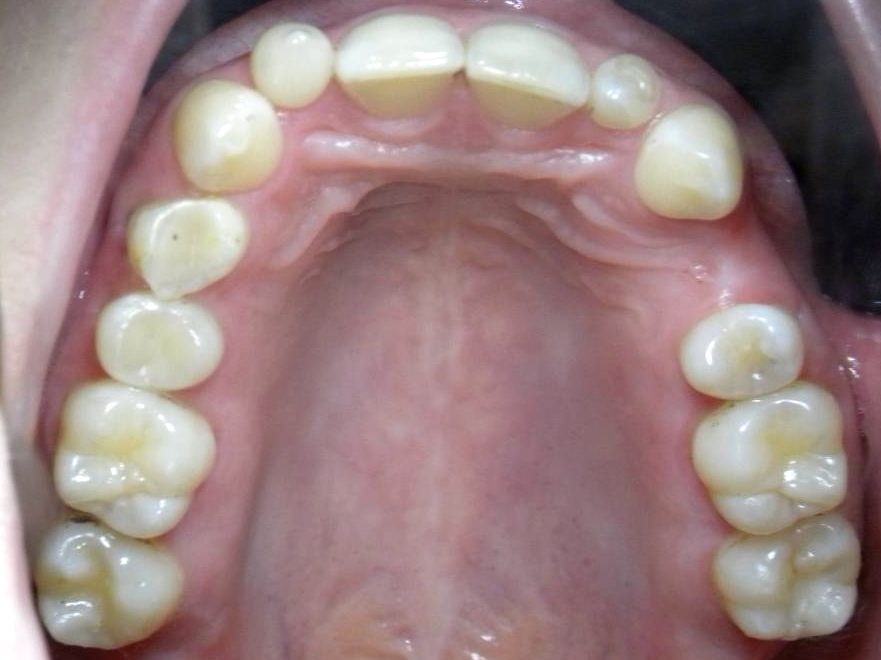 Oclusal Superior