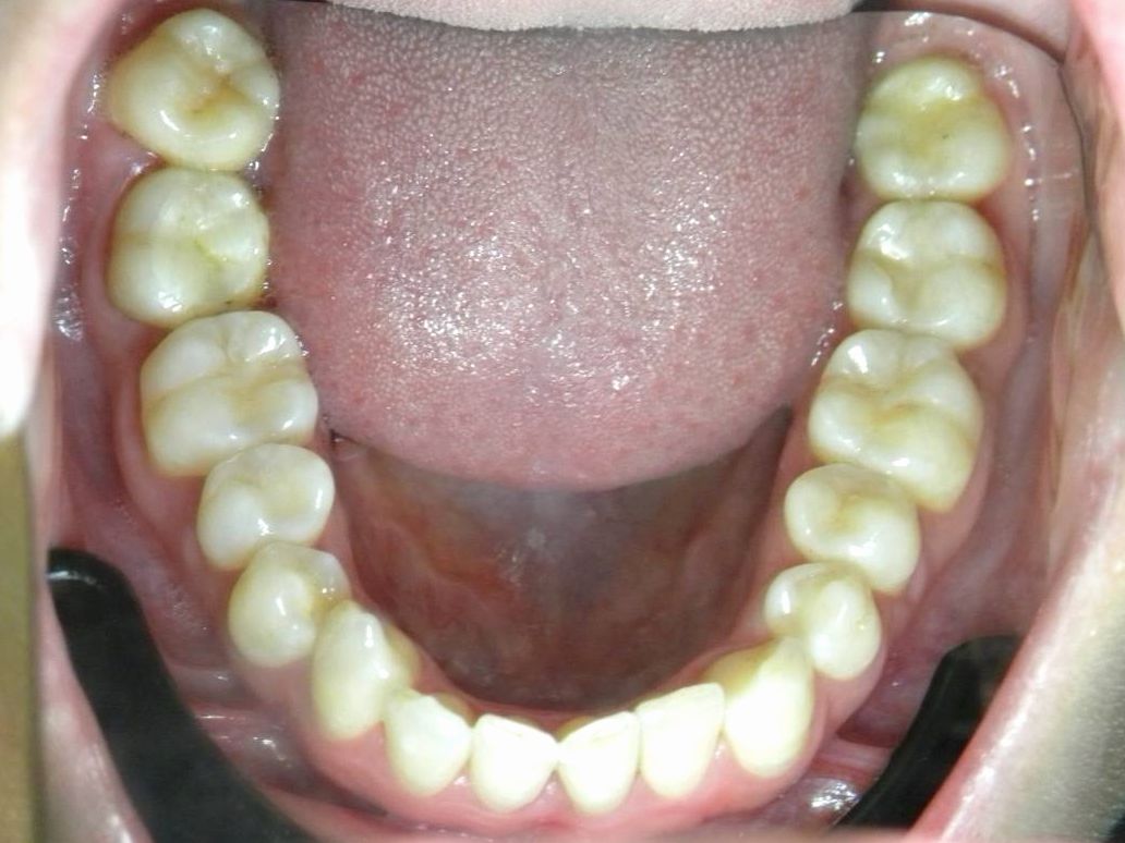 Oclusal Inferior