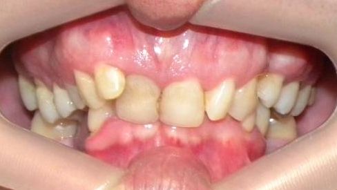 Frontal (Oclusión)