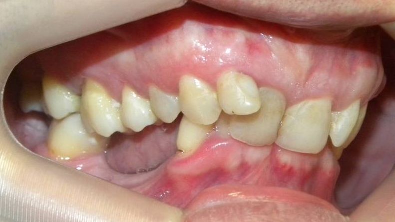 Lateral Derecha