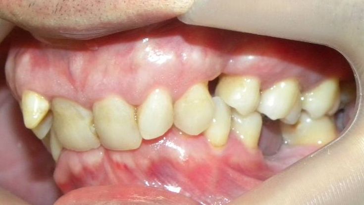 Lateral Izquierda