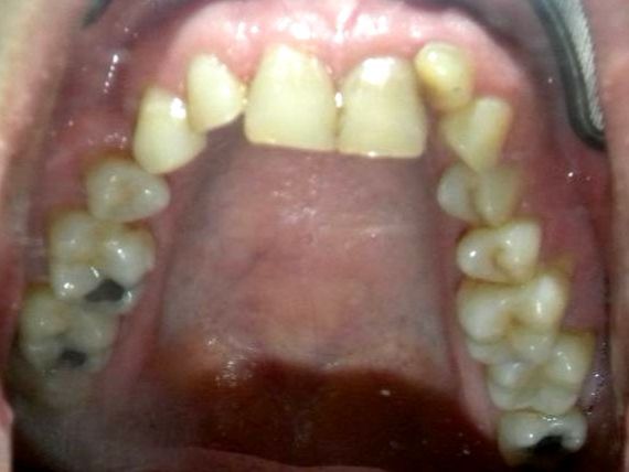 Oclusal Superior
