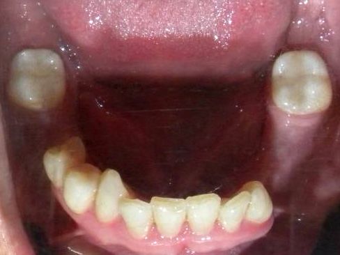 Oclusal Inferior