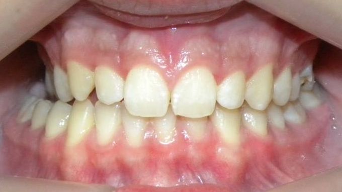 Frontal (Oclusión)
