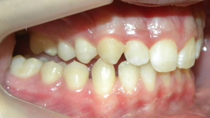Lateral Derecha