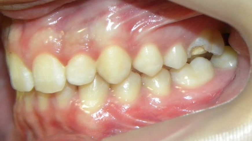 Lateral Izquierda