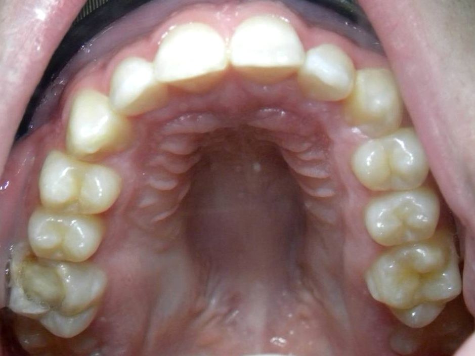 Oclusal Superior