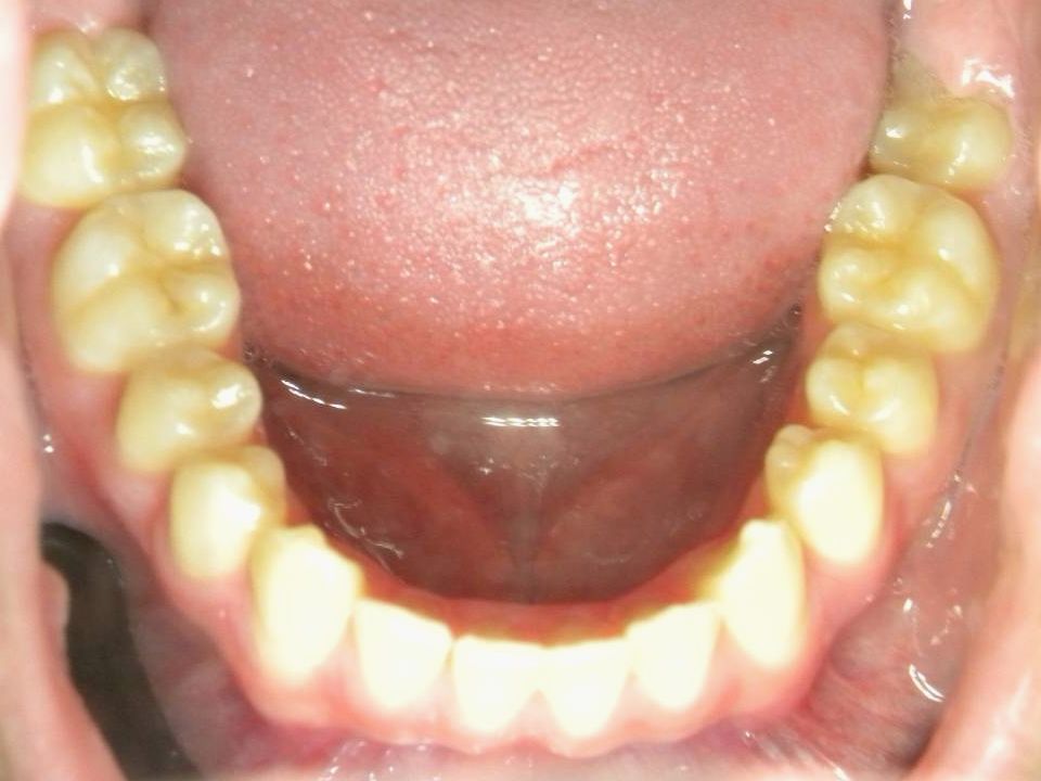 Oclusal Inferior
