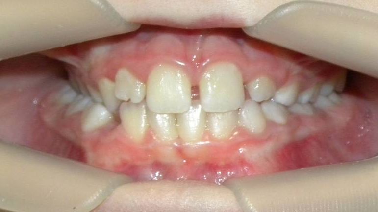 Frontal (Oclusión)