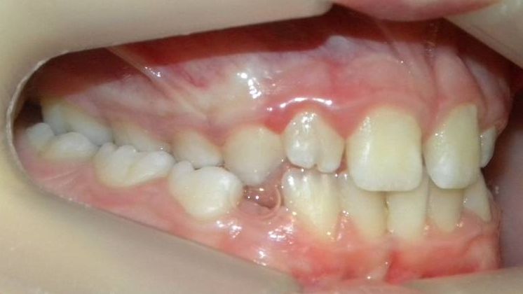 Lateral Derecha