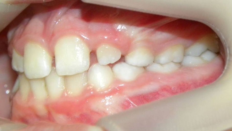Lateral Izquierda