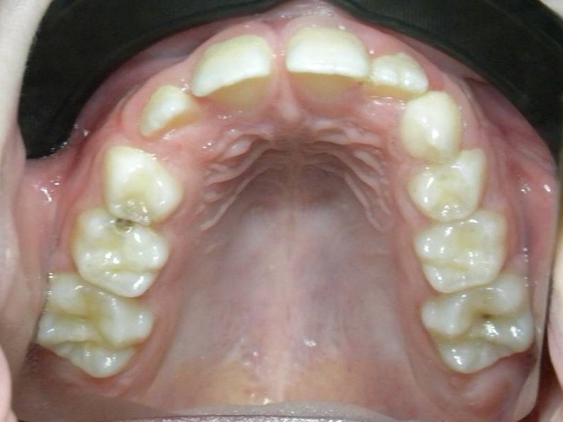 Oclusal Superior