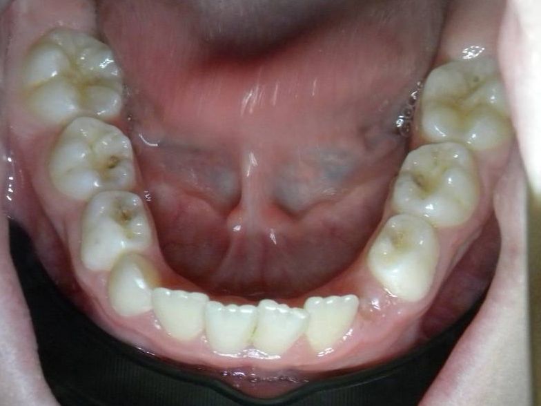 Oclusal Inferior
