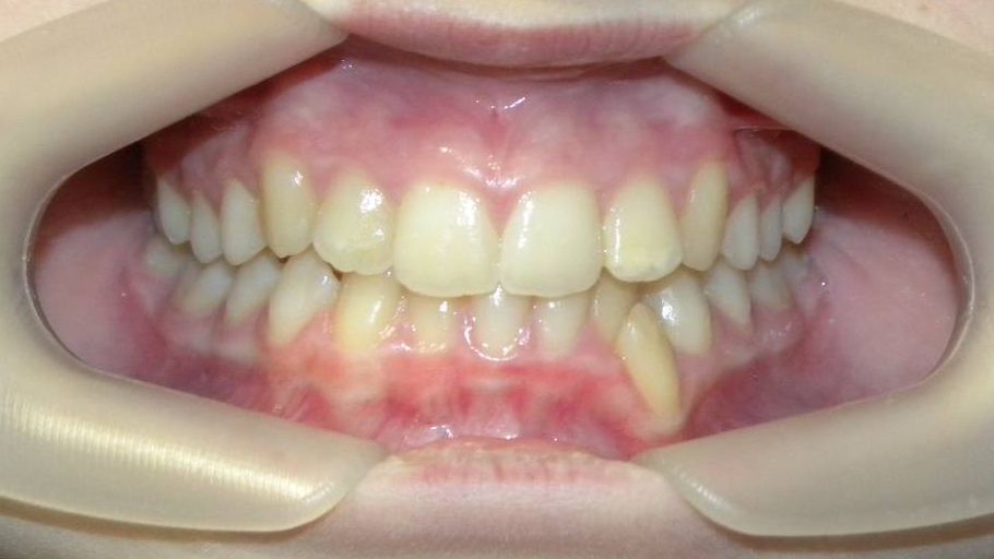 Frontal (Oclusión)