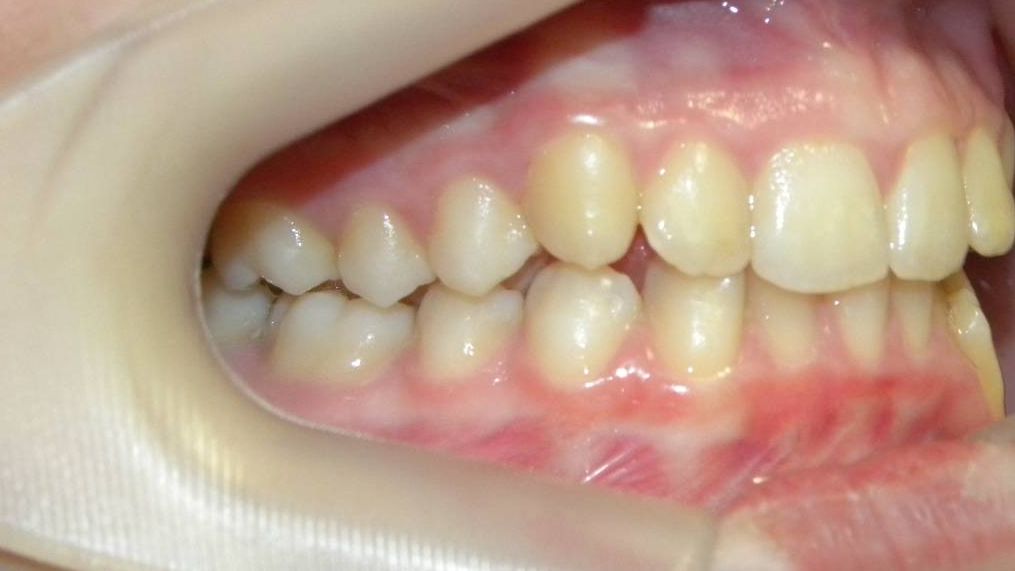 Lateral Derecha