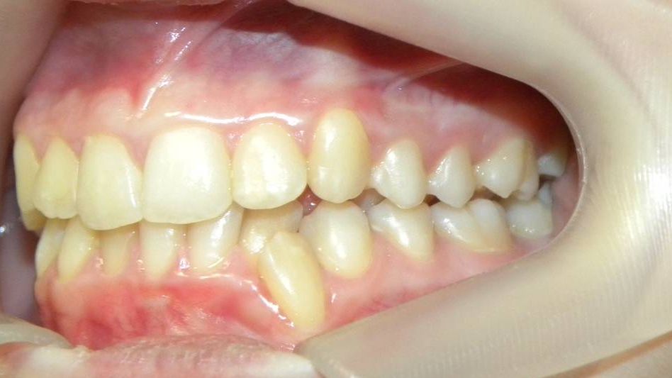 Lateral Izquierda