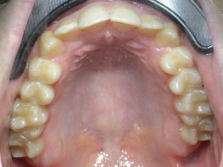 Oclusal Superior