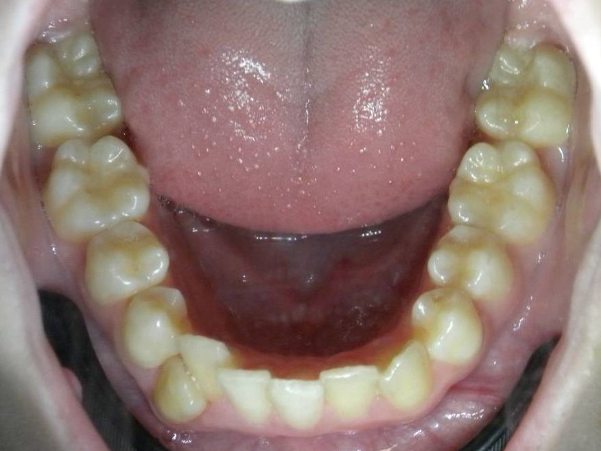 Oclusal Inferior